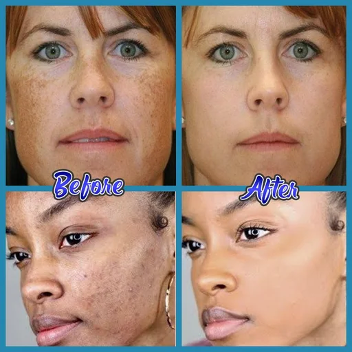 Anti-Blemish-Facial-Cream-2