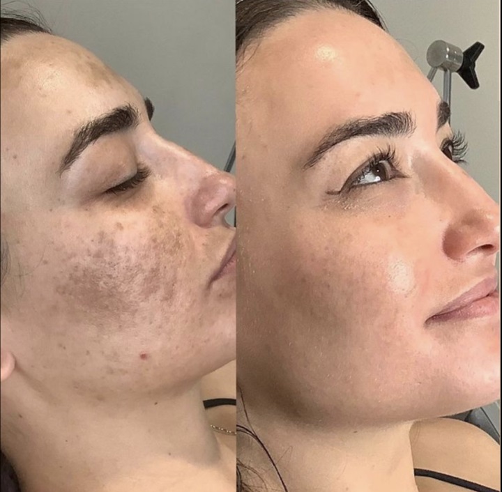 Chemical-Peel-Before-after-image-at-Medical-Day-Spa-of-Chapel-Hill-NC-720x706-1