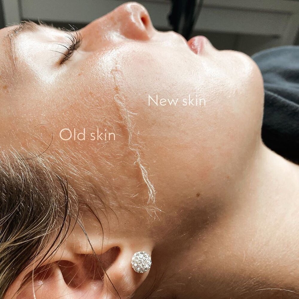 Dermaplaningnewskin